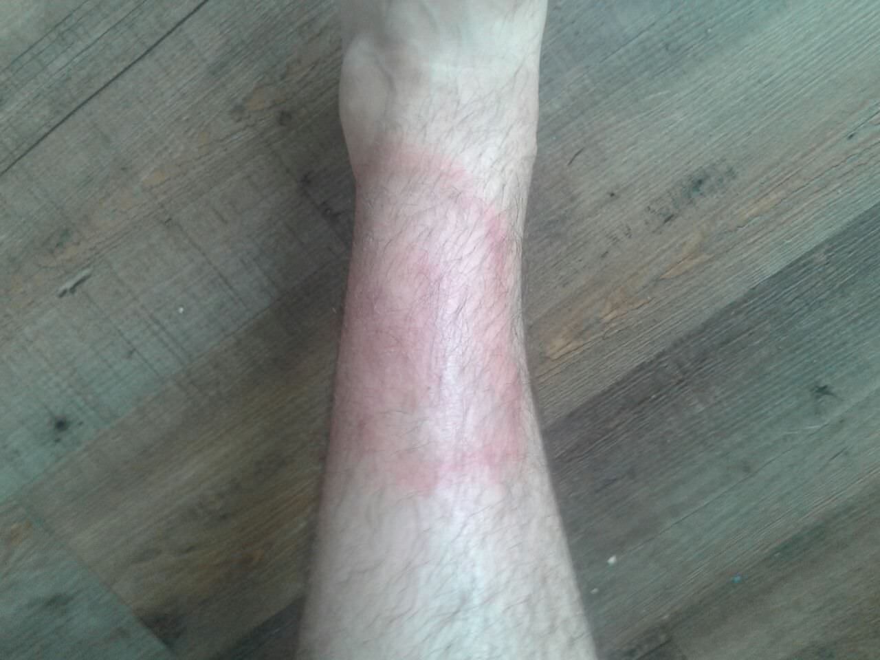 Rode vlek op onderbeen