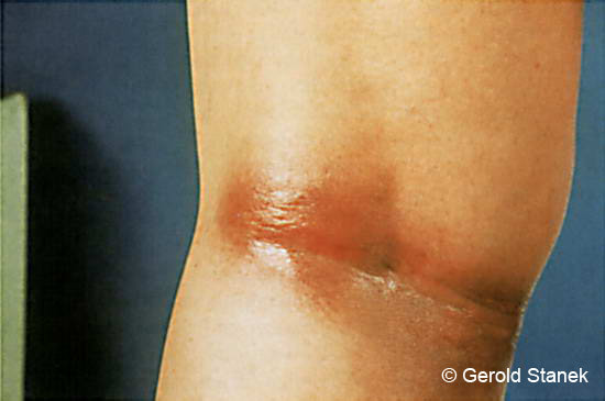 Rode vlek in knieholte