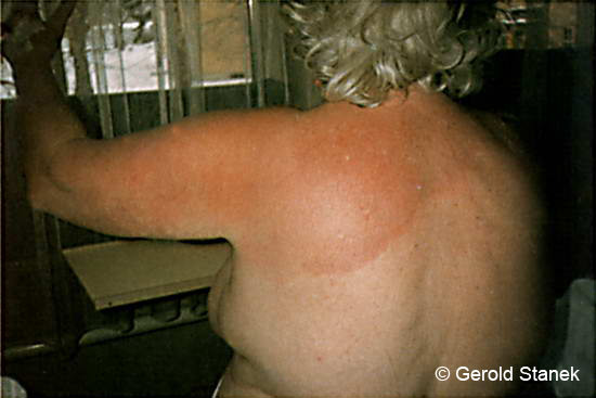 Rode vlek op schouder